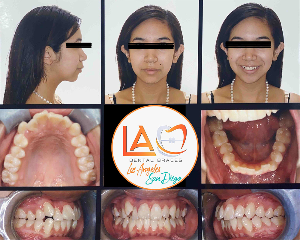 Before and After Photos LA Dental Braces